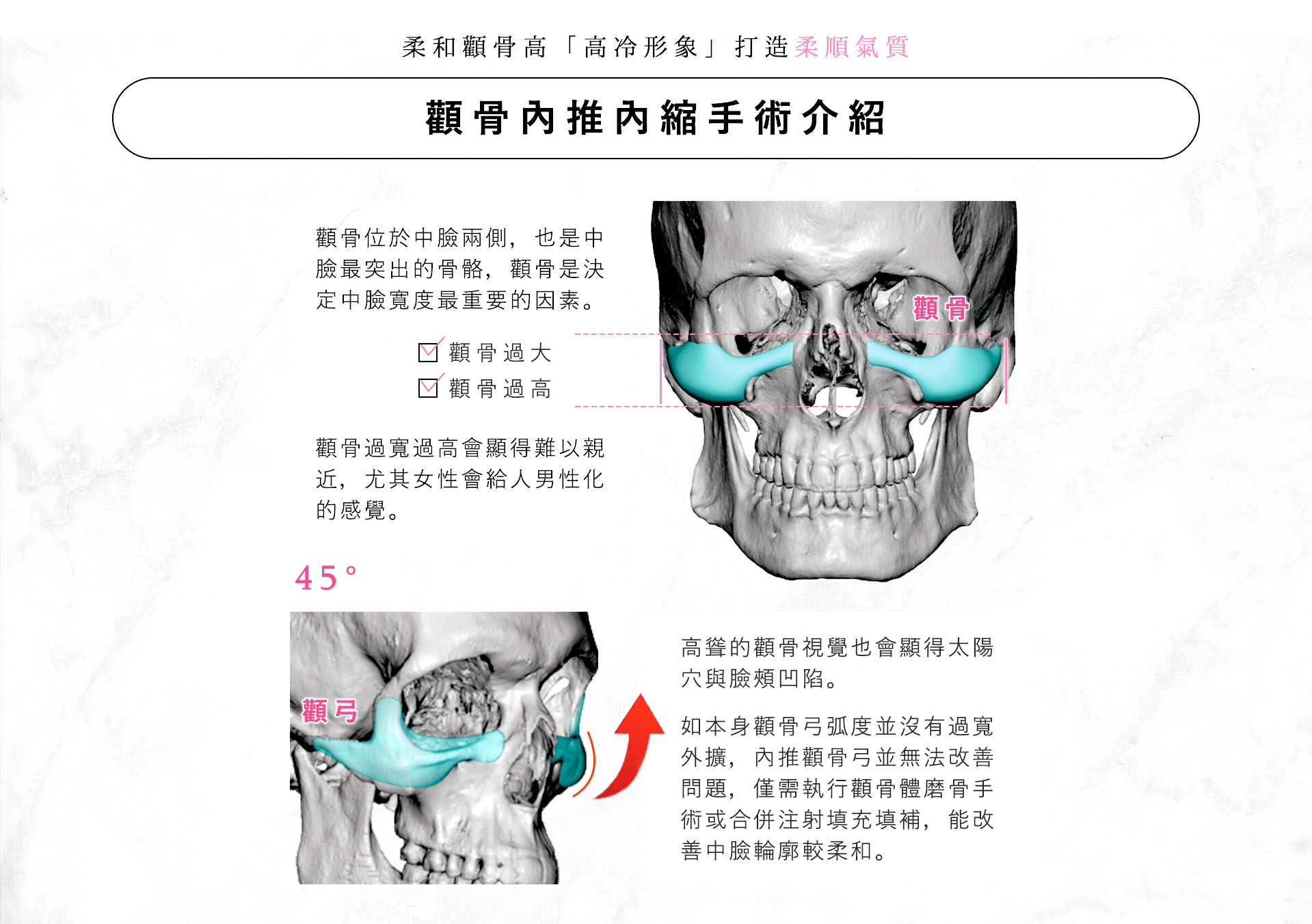 台南高雄削骨手術,台南高雄顴骨內推,台南高雄下顎骨角削骨,台南高雄下巴截骨