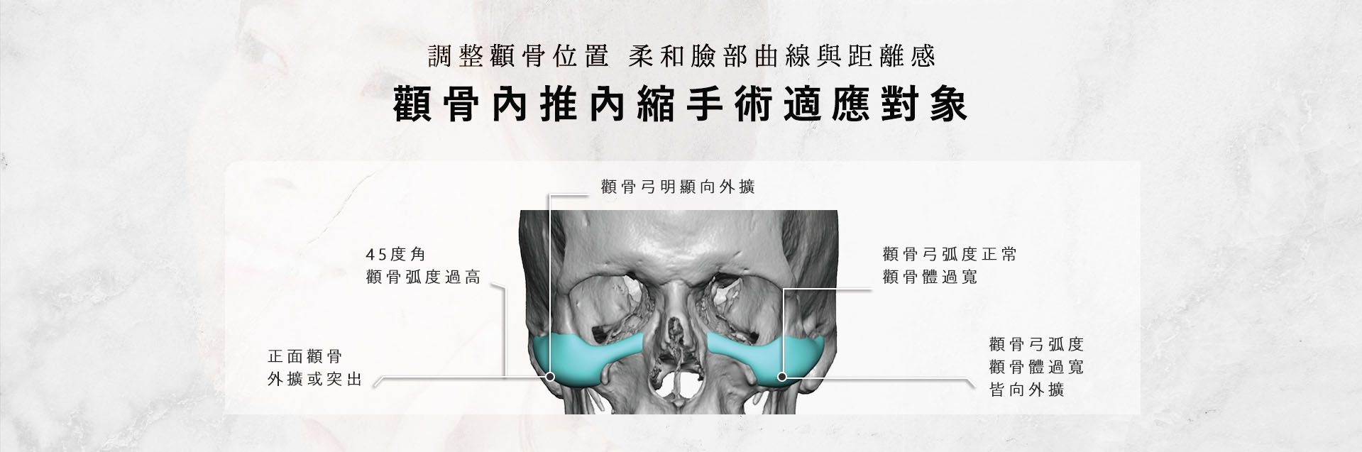 台南高雄削骨手術,台南高雄顴骨內推,台南高雄下顎骨角削骨,台南高雄下巴截骨