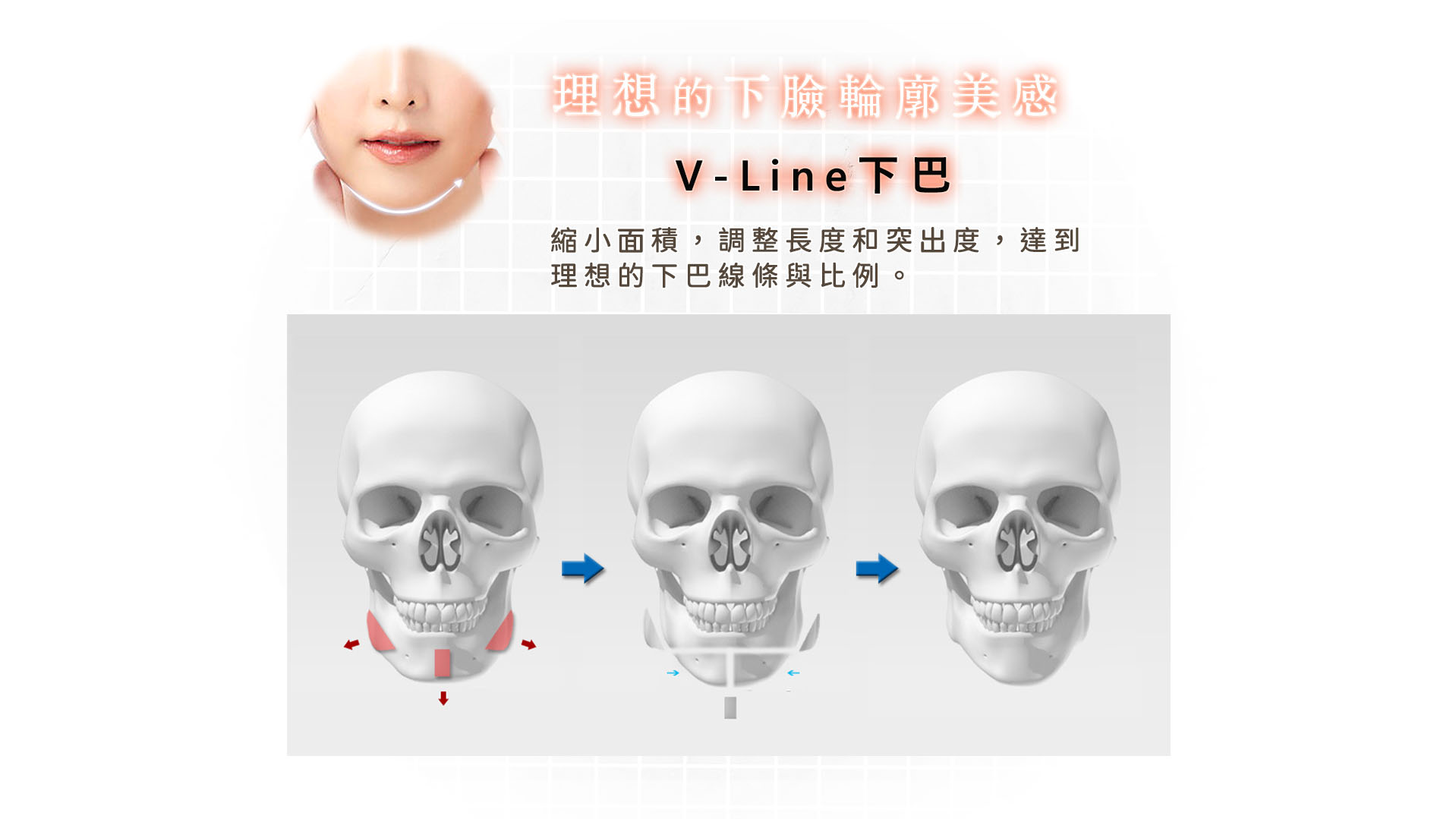 台南高雄削骨手術,台南高雄顴骨內推,台南高雄下顎骨角削骨,台南高雄下巴截骨