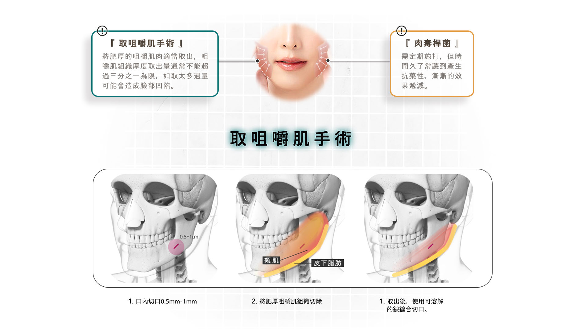 台南高雄削骨手術,台南高雄顴骨內推,台南高雄下顎骨角削骨,台南高雄下巴截骨