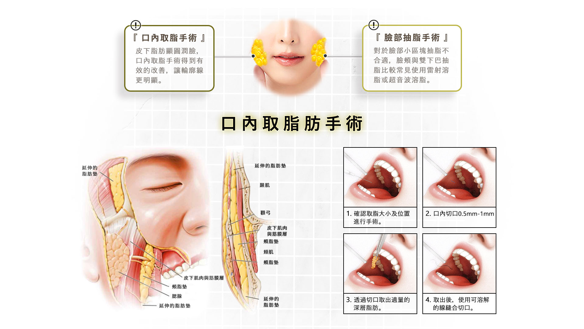 台南高雄削骨手術,台南高雄顴骨內推,台南高雄下顎骨角削骨,台南高雄下巴截骨