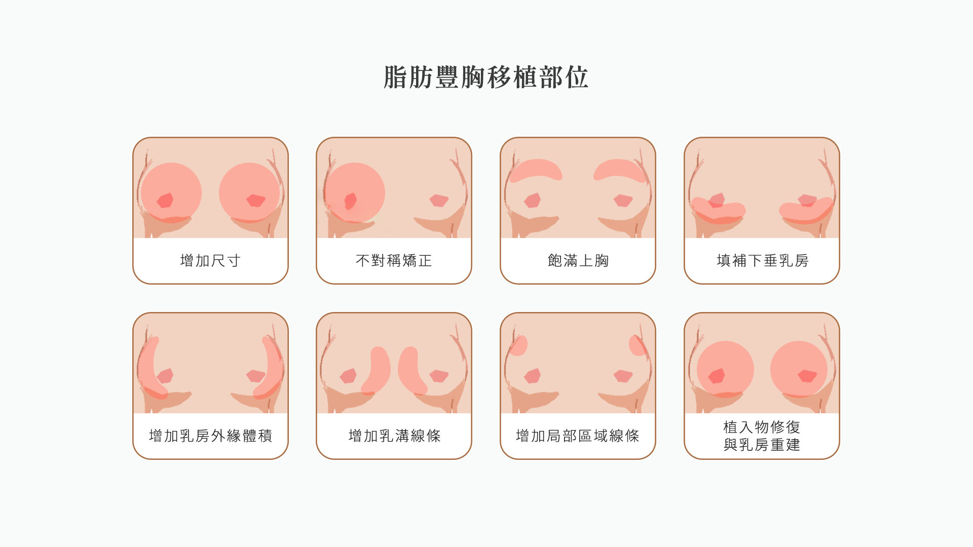 自體脂肪隆乳移植部位？_自體脂肪隆乳