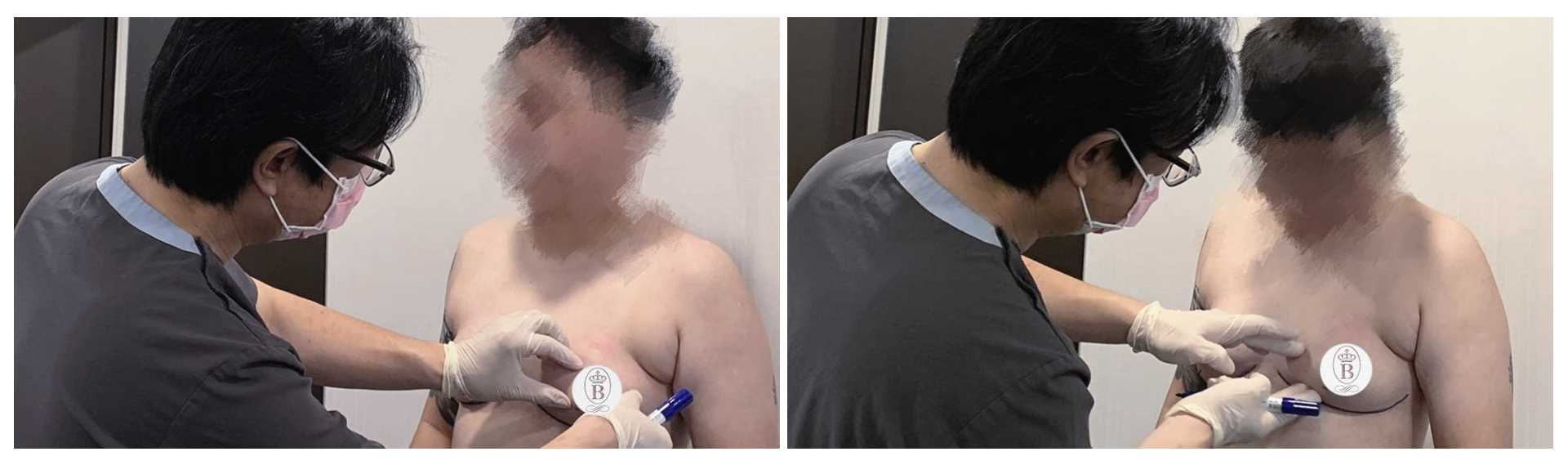 高雄台南平胸縮胸切乳手術權威醫師推薦011