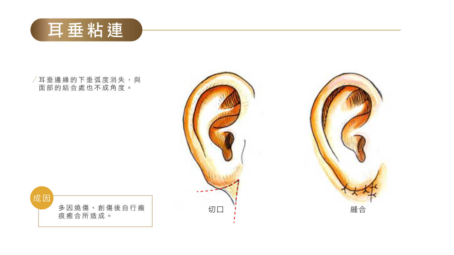 高雄耳朵整形招風耳.大耳縮.小耳垂修復形狀改善價格費用權威醫師推薦25