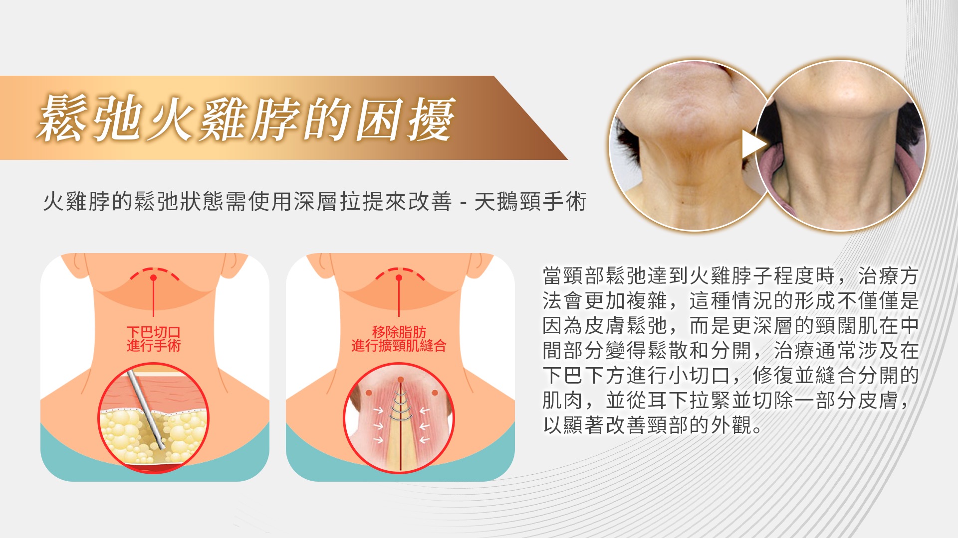 高雄天鵝頸手術權威醫師推薦006