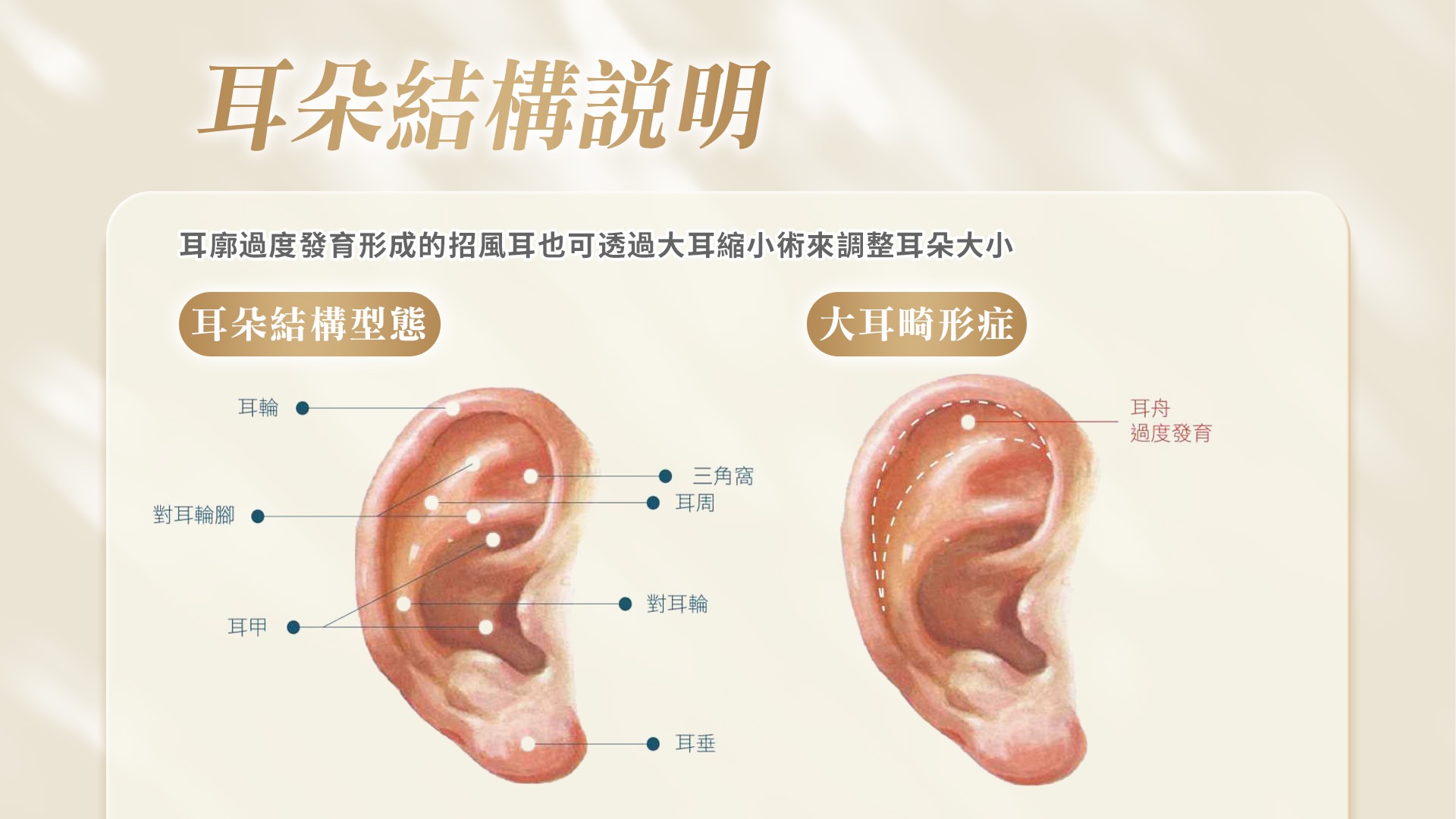 高雄耳朵整形招風耳.大耳縮.小耳垂修復形狀改善價格費用權威醫師推薦18