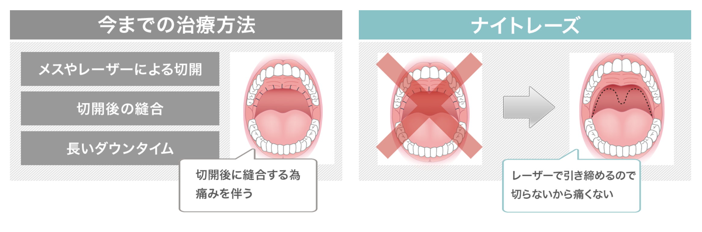 高雄打鼾止鼾打呼治療手術價格費用權威醫師推薦005