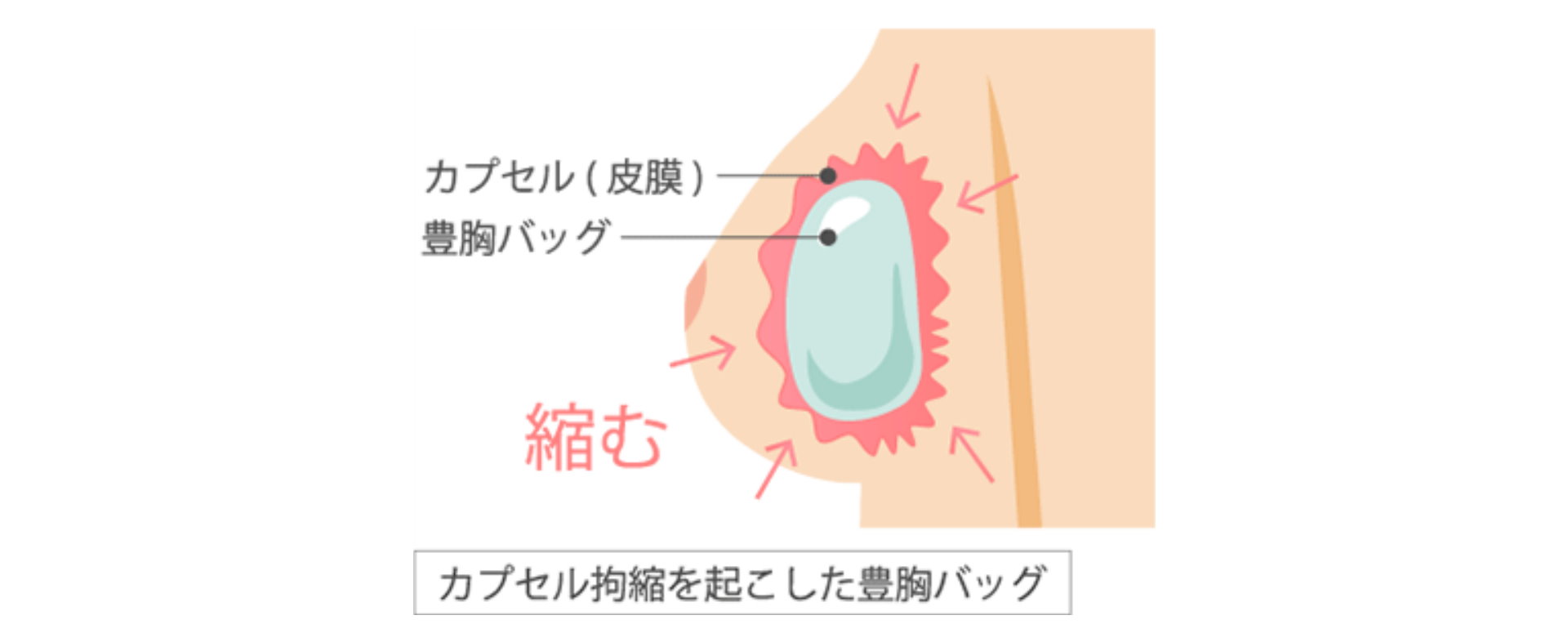 高雄隆乳失敗問題莢膜攣縮Dr.邱智弘醫師隆乳權威能重建