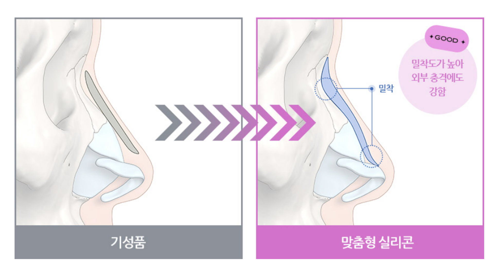 高雄韓國fitme3D列印隆鼻權威醫師診所推薦價格費用04