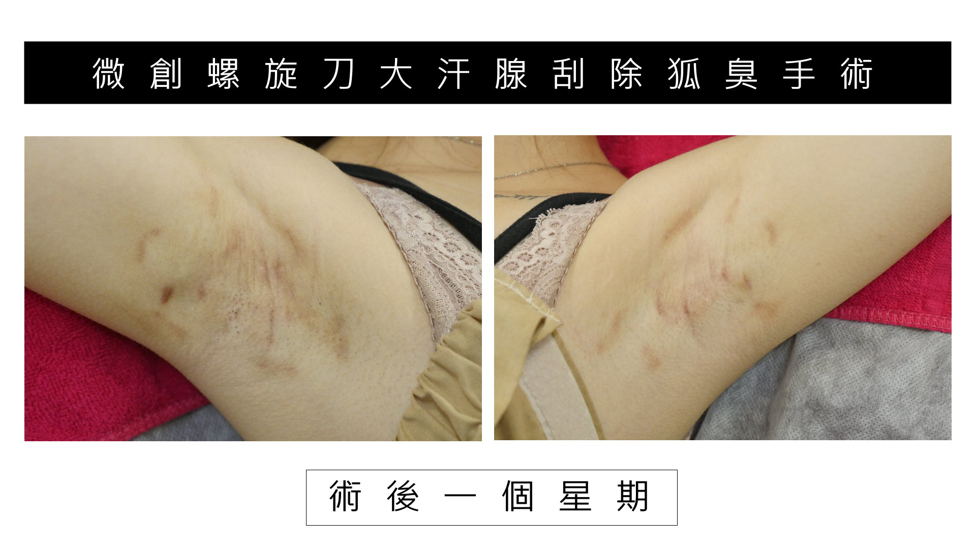 高雄除狐臭手術權威醫師價格費用01
