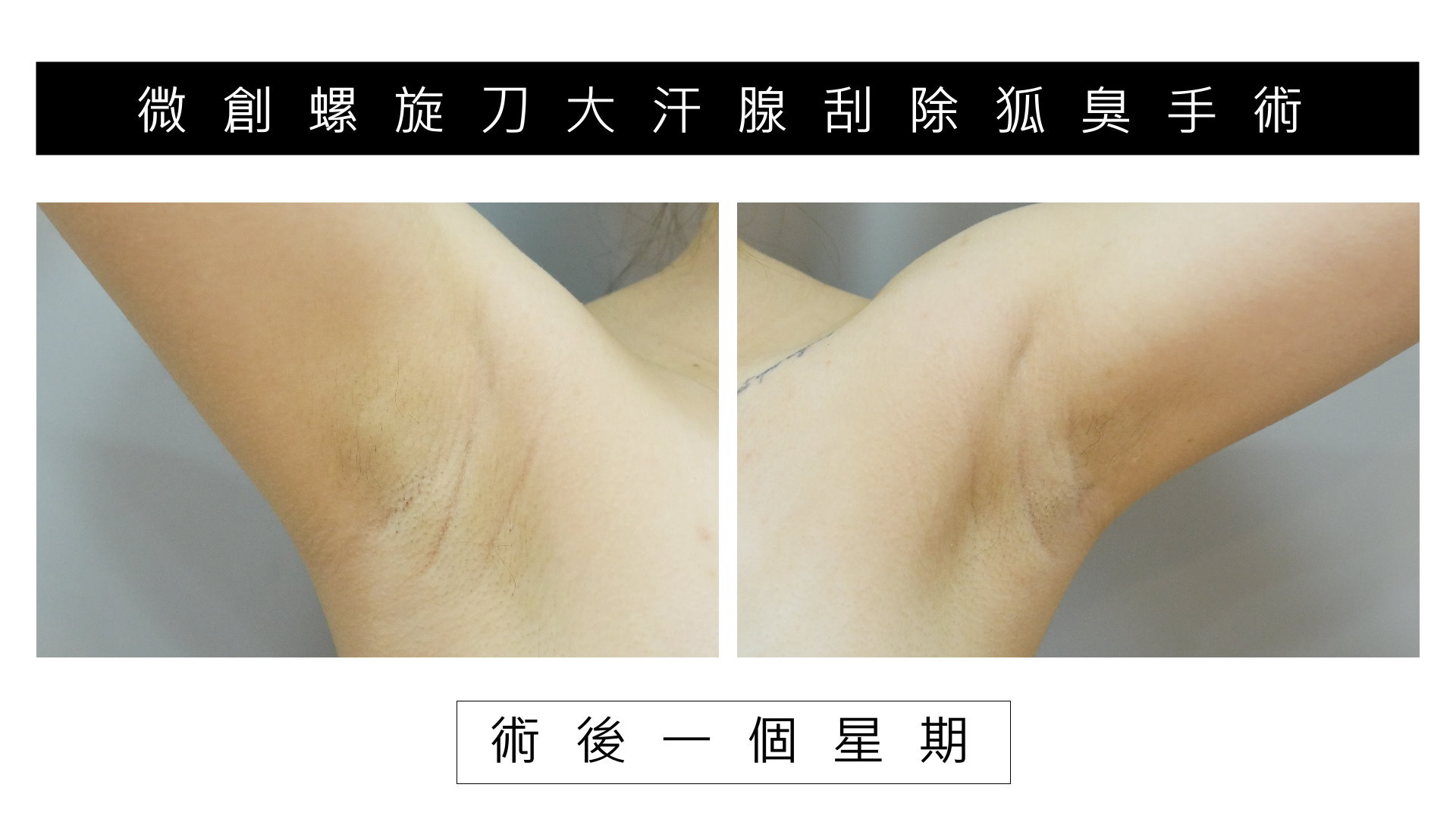 高雄除狐臭手術權威醫師價格費用02