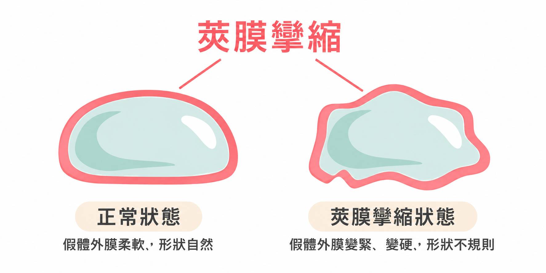 高雄隆乳失敗問題假體破裂Dr.邱智弘醫師隆乳權威能重建