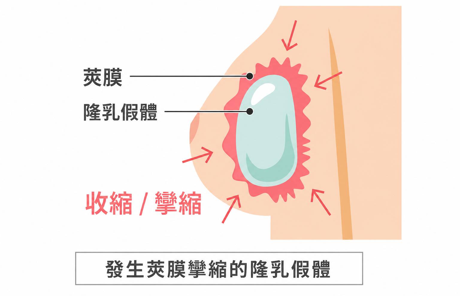 高雄隆乳失敗問題莢膜攣縮Dr.邱智弘醫師隆乳權威能重建