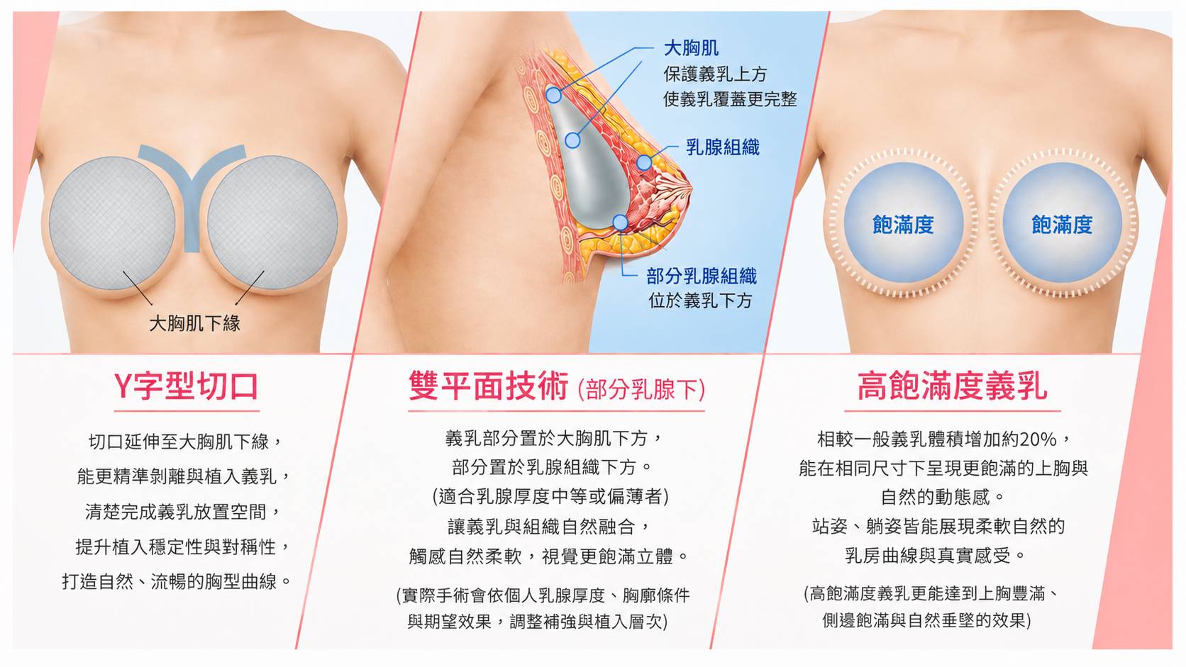 隆乳假體位置示意,高雄隆乳診所,隆乳手術假體