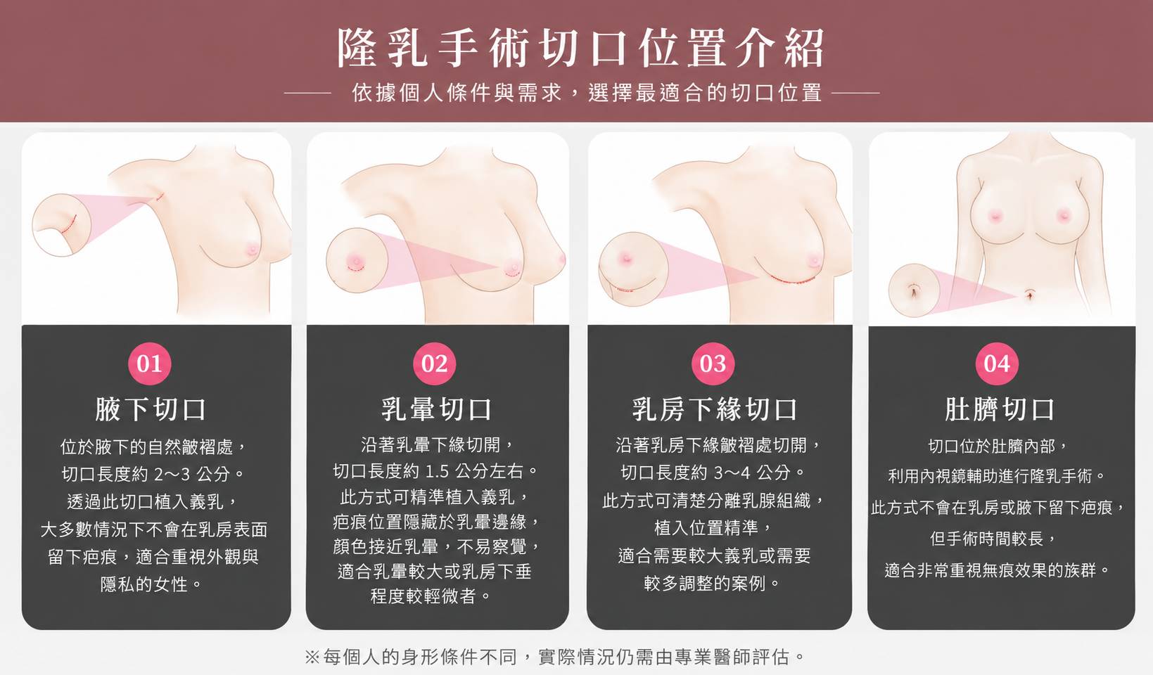 隆乳假體植入位置,高雄隆乳醫美,高雄隆乳說明