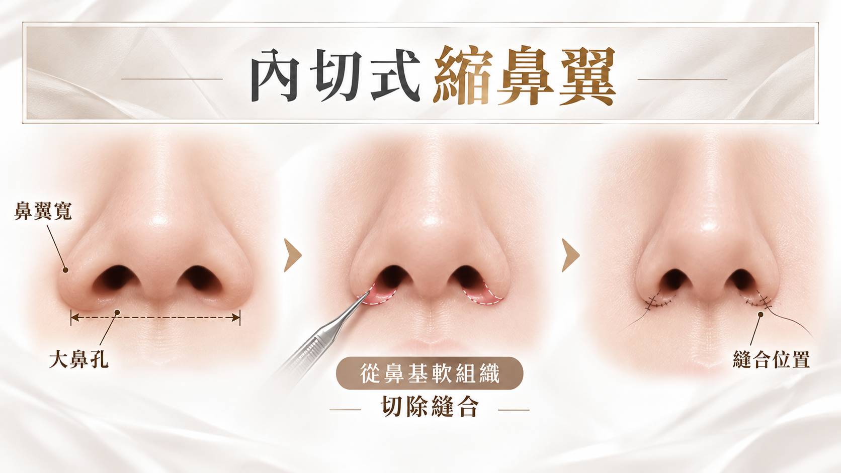 高雄縮鼻翼縮鼻孔手術權威醫師推薦價格費用多少005