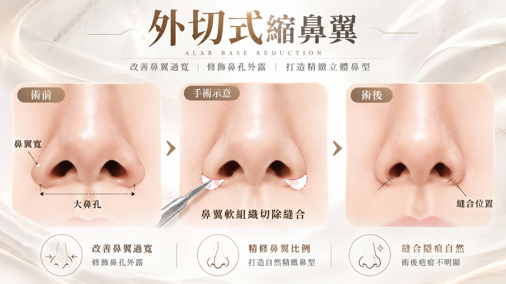 高雄縮鼻翼縮鼻孔手術權威醫師推薦價格費用多少006